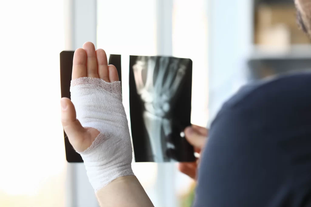 Bone Fracture Lawyer